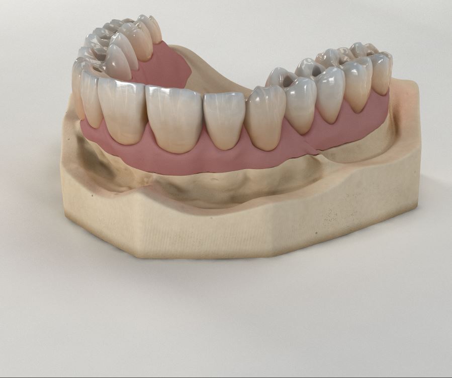 Implantatkronen 17-27